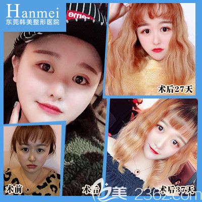 東莞韓美整形醫(yī)院李陽院長隆鼻案例