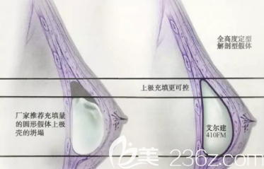 水滴形假體和圓形假體的填充乳房示意圖