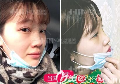 鼻整形術(shù)后3天樣子