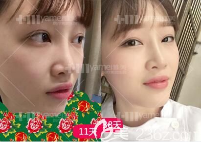 鼻整形拆線后恢復(fù)效果