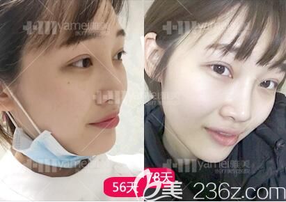 做完鼻整形術(shù)后1個(gè)月后效果情況