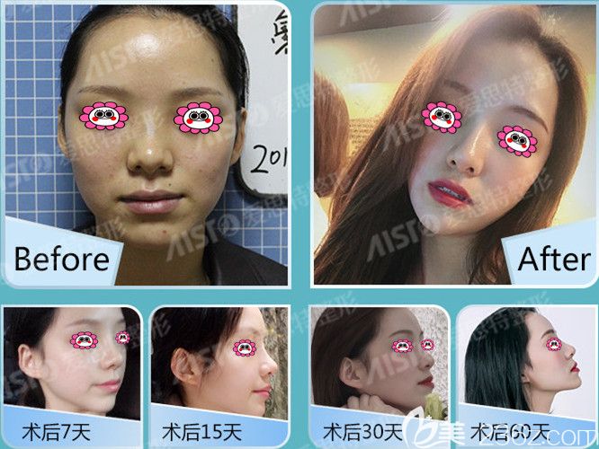 無錫愛思特陳煒醫(yī)生隆鼻變化圖