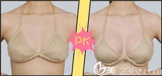 無錫愛思特郭曄豐胸對(duì)比圖