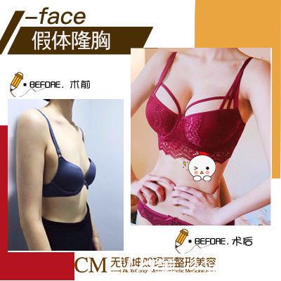 無錫坤如瑪麗醫(yī)院豐胸對比圖