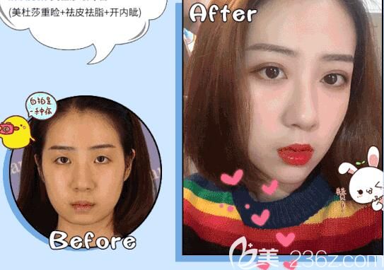 徐國(guó)建院長(zhǎng)做切開雙眼皮術(shù)后150天恢復(fù)效果