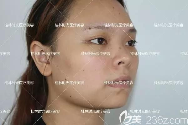 我在桂林時光整形做鼻綜合和假體墊下巴前 我在桂林時光整形做鼻綜合和假體墊下巴前