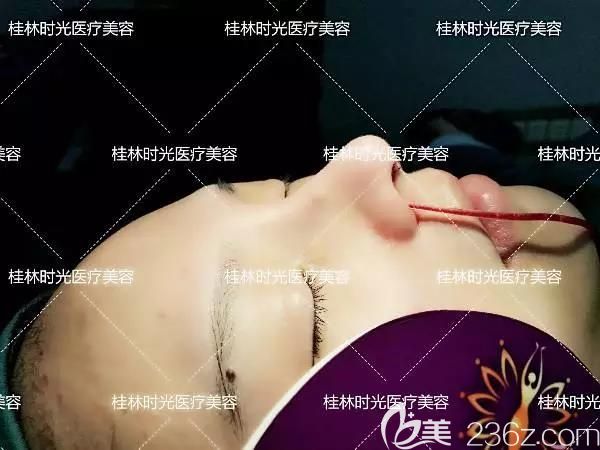 桂林時光院長給我做鼻綜合手術中 桂林時光院長給我做鼻綜合手術中