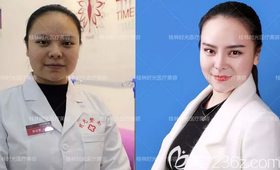 我在桂林時光整形做鼻子和下巴前后對比照片 我在桂林時光整形做鼻子和下巴前后對比照片