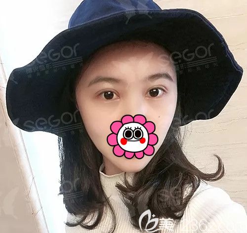 術(shù)后一周PARK法雙眼皮恢復(fù)情況