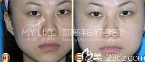 貴陽美萊光子嫩膚案例