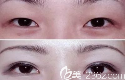 貴陽美萊雙眼皮怎么樣