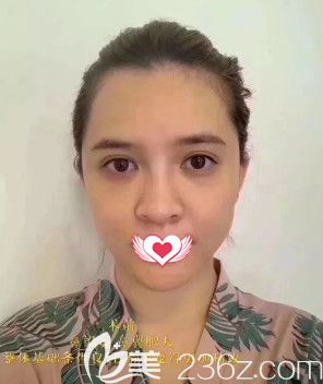 在邢臺(tái)美加美做鼻綜合前鼻子塌平 在邢臺(tái)美加美做鼻綜合前鼻子塌平