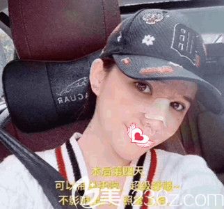 陳譽(yù)華院長為我做鼻綜合4天后基本消腫 陳譽(yù)華院長為我做鼻綜合4天后基本消腫