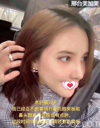 美加美整形院長陳譽(yù)華做鼻綜合6天進(jìn)行拆線 美加美整形院長陳譽(yù)華做鼻綜合6天進(jìn)行拆線