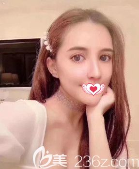 記錄在邢臺遇見美做鼻綜合術后1個月的恢復情況 沒想到我的矮塌鼻也能蛻變歐美范的高挺鼻