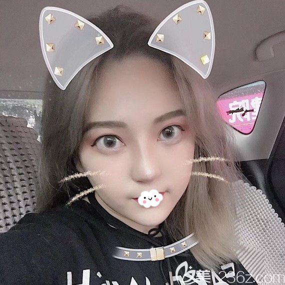 武漢壹加壹李艷東韓式生科假體隆鼻術(shù)后效果