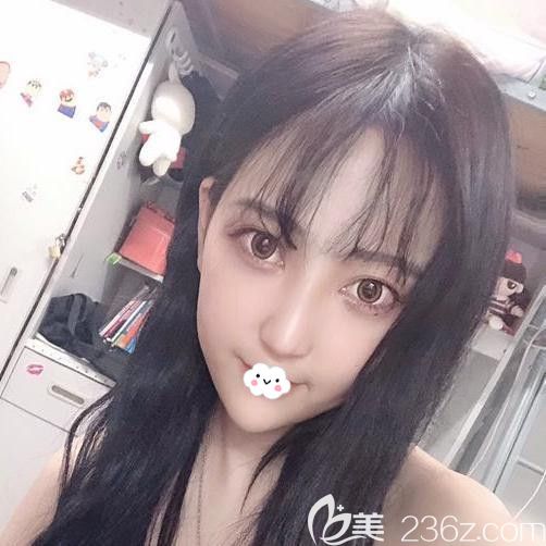 武漢壹加壹李艷東假體隆鼻案例術(shù)后恢復效果圖