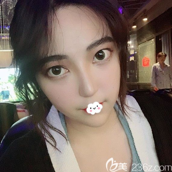 武漢隆鼻哪家醫(yī)院好？武漢壹加壹李艷東鼻綜合案例