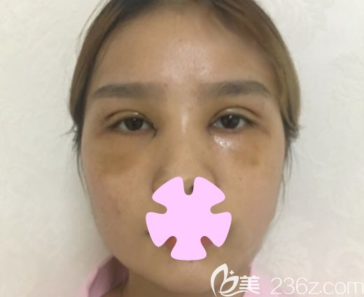 我在桂林華美整形做雙眼皮加激光祛斑第6天