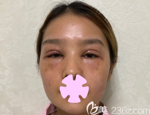 我在桂林華美做無痕雙眼皮和祛斑術(shù)后第2天
