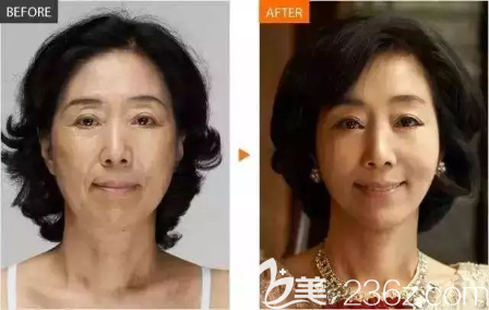 貴陽華美微雕逆齡術5大技術優(yōu)勢及真人案例見證線雕效果好不好。