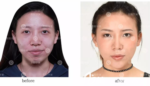 貴陽華美整形玻尿酸豐蘋果肌太陽穴墊下巴等案例效果集錦