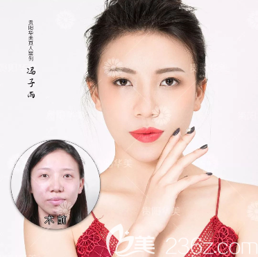 玻尿酸填充術(shù)后效果