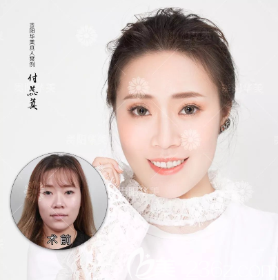 貴陽華美玻尿酸注射前后對比