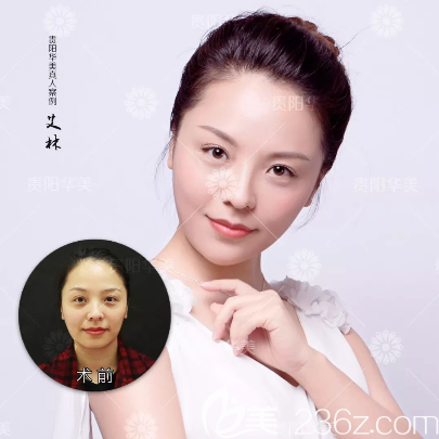 玻尿酸豐下巴案例