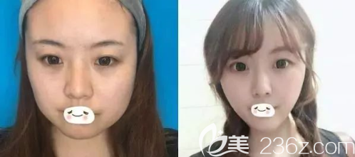 貴陽美貝爾瘦臉效果怎么樣