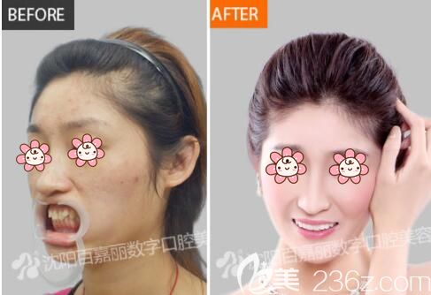 劉文波醫(yī)生做牙齒矯正與皮膚改善術(shù)后恢復(fù)對(duì)比
