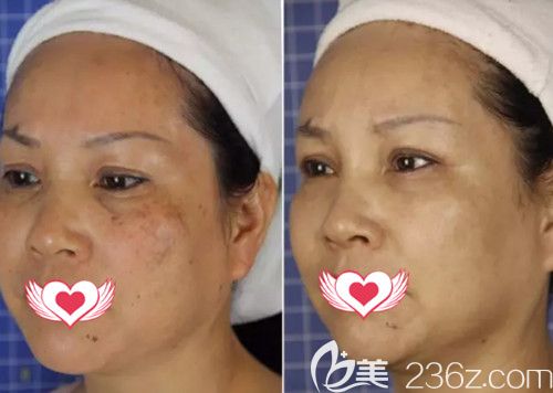 王醫(yī)生做激光祛斑案例 王醫(yī)生做激光祛斑案例