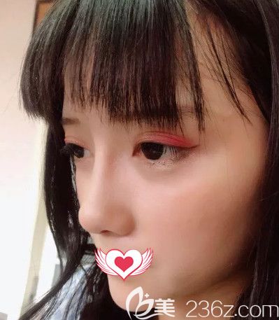 張丙海醫(yī)生做自體軟骨隆鼻術(shù)后25天完全消腫