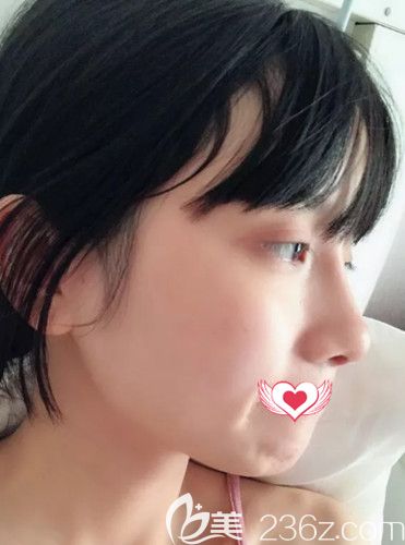 邯鄲京美張丙海做完自體軟骨隆鼻術(shù)后10天消腫