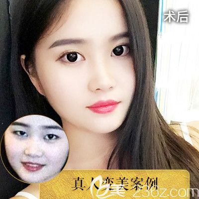 中信惠州醫(yī)院整形科羅秋雄醫(yī)生雙眼皮對(duì)比圖 中信惠州醫(yī)院整形科羅秋雄醫(yī)生雙眼皮對(duì)比圖