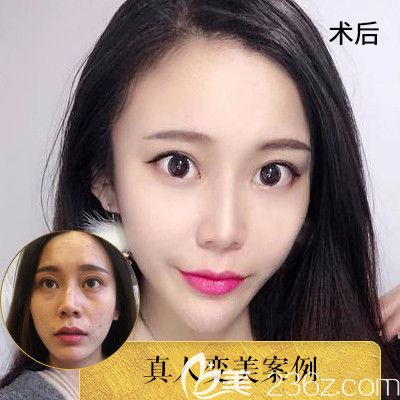 中信惠州醫(yī)院整形科羅秋雄對(duì)比圖 中信惠州醫(yī)院整形科羅秋雄對(duì)比圖