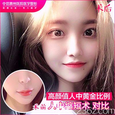 中信惠州醫(yī)院整形科羅秋雄做的人中縮短手術(shù)對(duì)比圖 中信惠州醫(yī)院整形科羅秋雄做的人中縮短手術(shù)對(duì)比圖