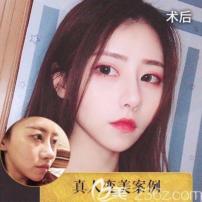 中信惠州醫(yī)院醫(yī)學(xué)整形隆鼻失敗修復(fù)對(duì)比圖 中信惠州醫(yī)院醫(yī)學(xué)整形隆鼻失敗修復(fù)對(duì)比圖