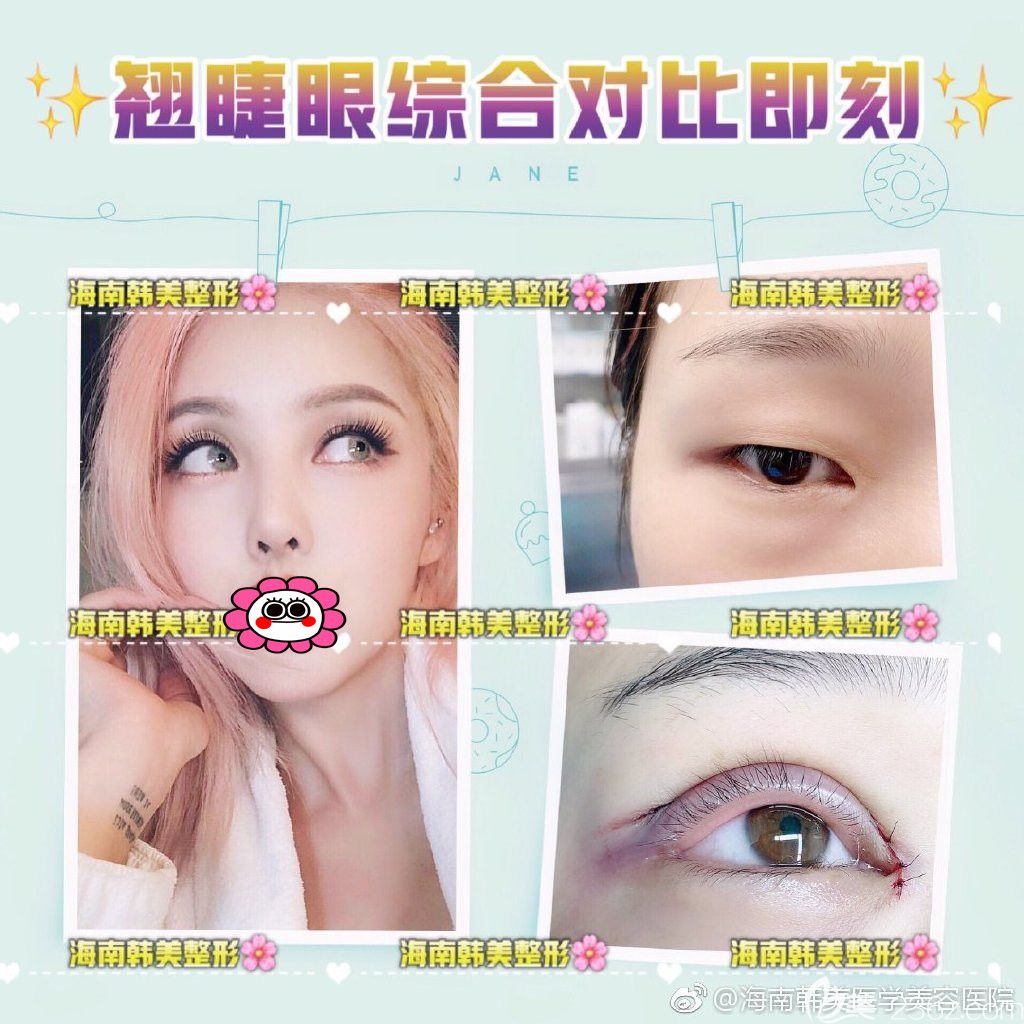 情人節(jié)海南韓美特惠整形價格來襲，雙眼皮低至1280元附陳柳藝/梁如光真人案例