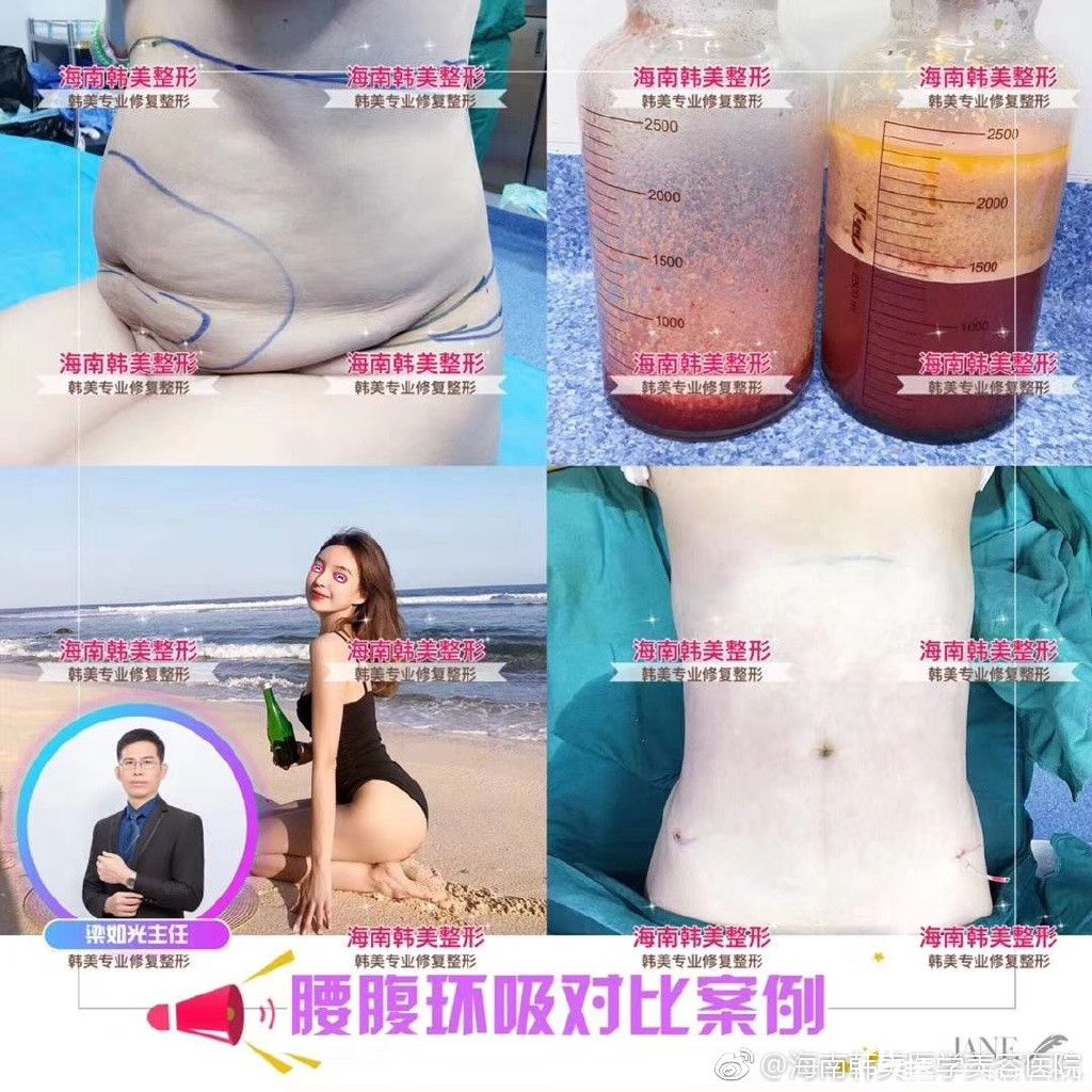 海南韓美醫(yī)學(xué)美容醫(yī)院吸脂案例前后對(duì)比圖
