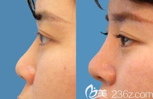 杜瑞醫(yī)生玻尿酸注射隆鼻案例對比 杜瑞醫(yī)生玻尿酸注射隆鼻案例對比