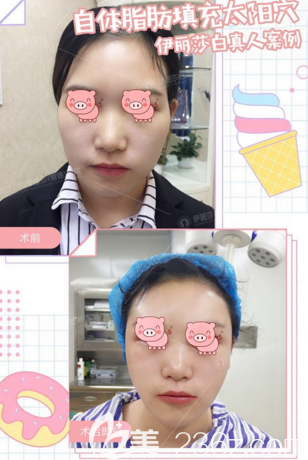 常德伊麗莎白自體脂肪填充真人案例