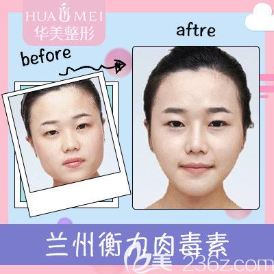 汕頭華美瘦臉680元附案例
