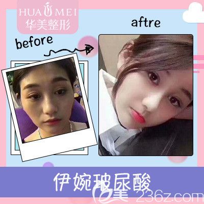 汕頭華美玻尿酸注射案例