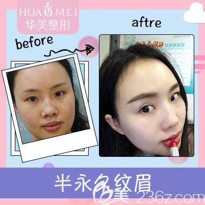 汕頭華美半紋眉案例對(duì)比圖