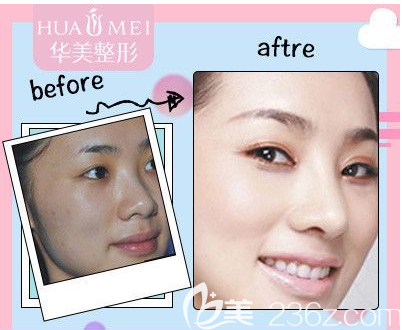 汕頭華美注射案例效果圖