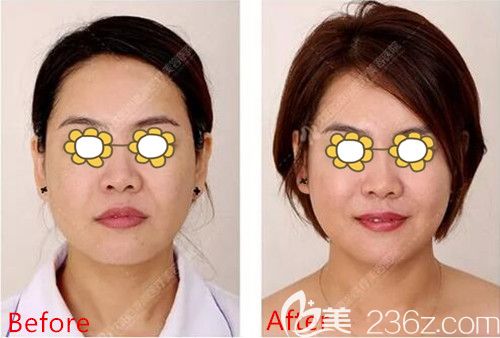 面部線雕+玻尿酸填充塑形術(shù)前術(shù)后對(duì)比