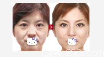 洛陽(yáng)華美醫(yī)療美容醫(yī)院羅定安案例 洛陽(yáng)華美醫(yī)療美容醫(yī)院羅定安案例