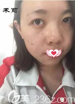 在<!--<i data=20240703-sp></i>-->整形美容醫(yī)院做果酸煥膚前皮膚粗糙 在<!--<i data=20240703-sp></i>-->整形美容醫(yī)院做果酸煥膚前皮膚粗糙