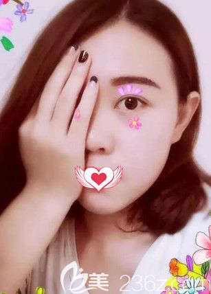 楊莎莎醫(yī)生為我做果酸換膚術(shù)后7天皮膚光滑細(xì)膩 楊莎莎醫(yī)生為我做果酸換膚術(shù)后7天皮膚光滑細(xì)膩